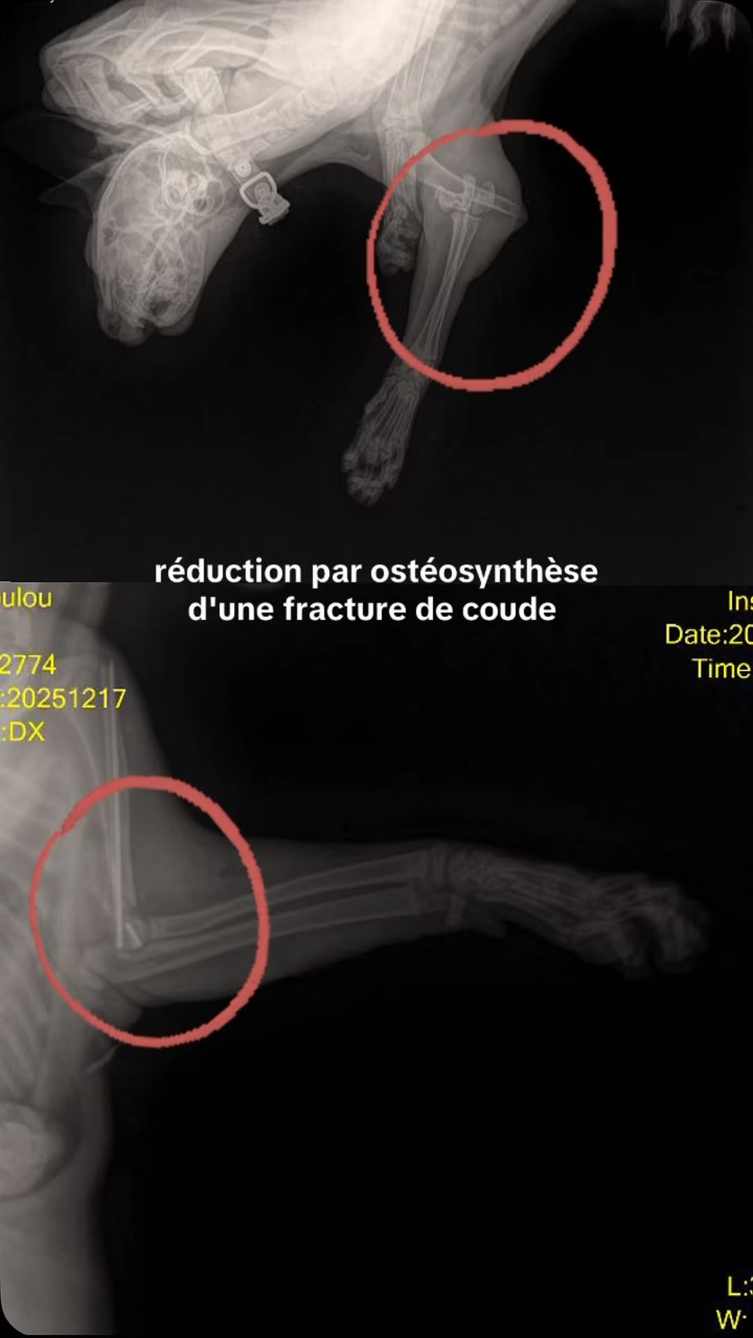 Un nouveau défi chirurgical relevé avec...